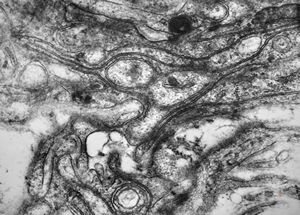 M,15y. | neurinoma - orbita M,15y. | neurinoma - orbita